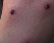 airsoft bruise thumbnail